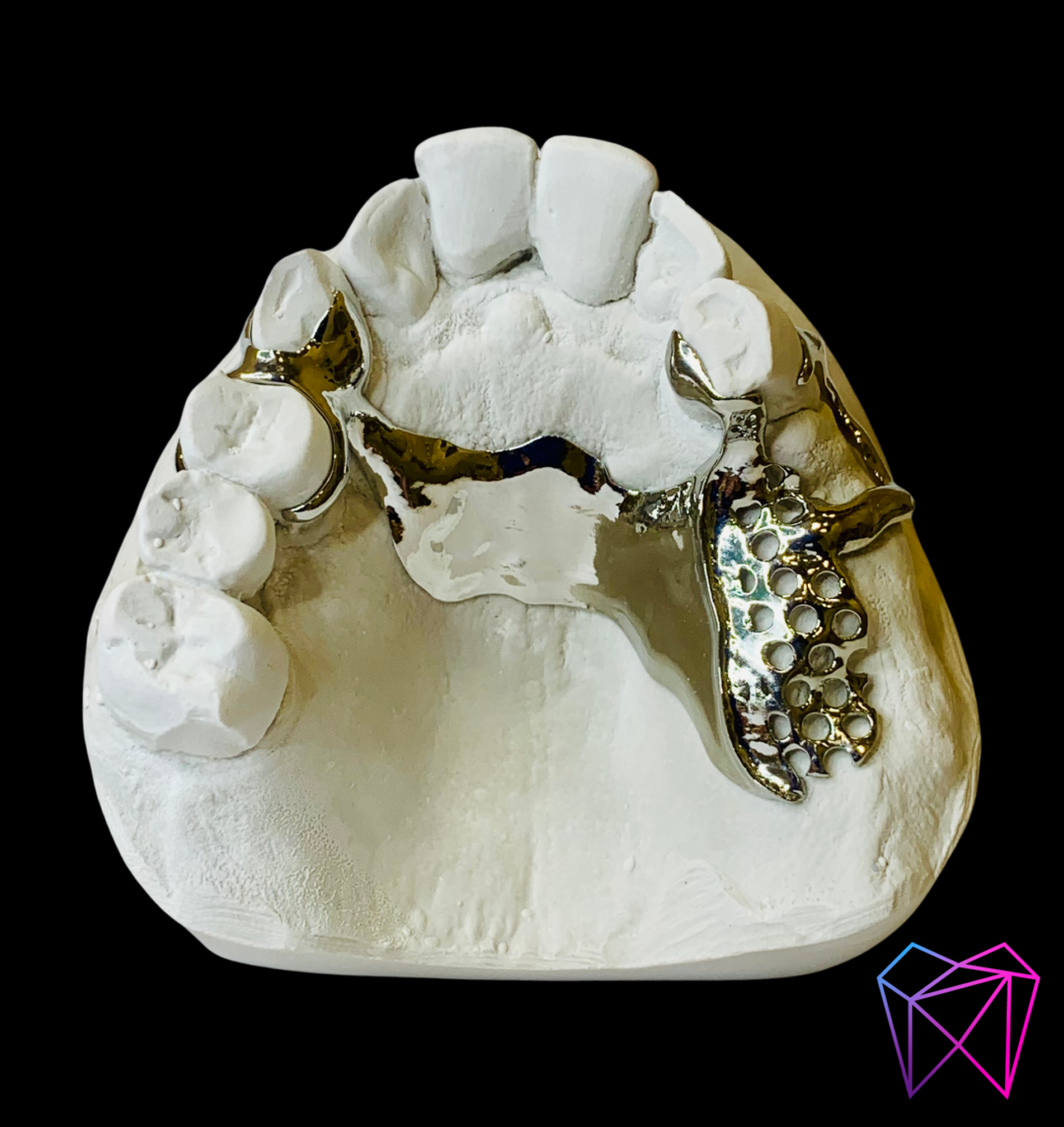 Prothèse amovible métallique – Image 3