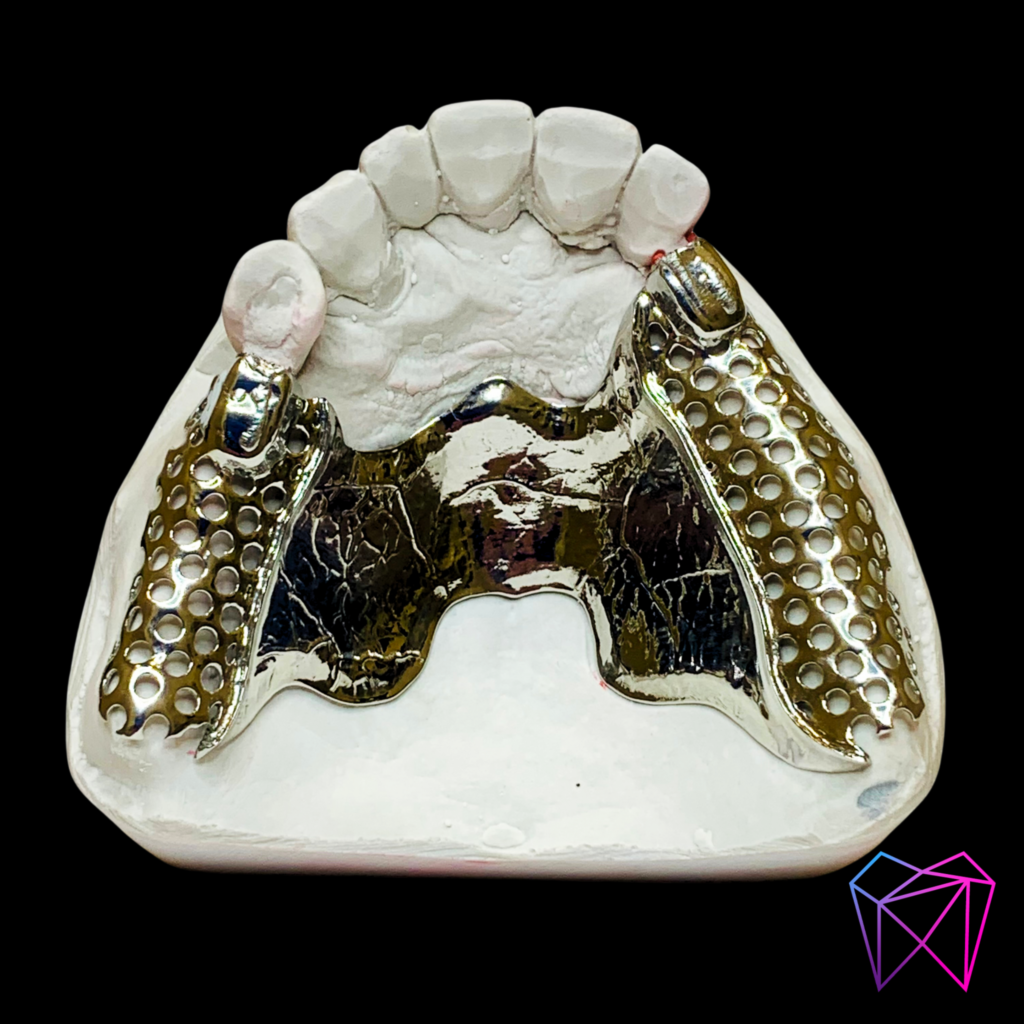 Prothèse amovible métallique – Image 4