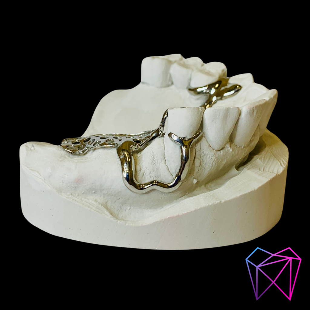Prothèse amovible métallique – Image 2