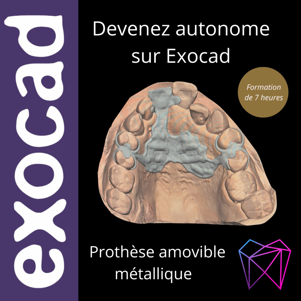 Devenez autonome sur Exocad – Prothèse amovible métallique