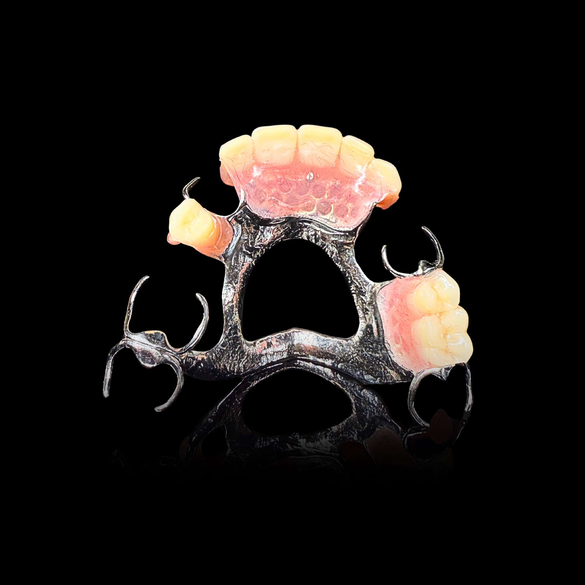 Prothèse amovible métallique